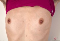 ATK hairy  in mature and hairy