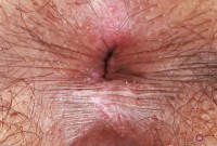 ATK hairy  in exotic and hairy