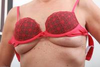 ATK hairy  in mature and hairy