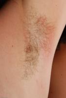 ATK hairy  in young and hairy