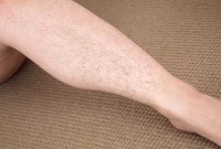 ATK hairy  in young and hairy