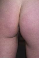 ATK hairy  in young and hairy