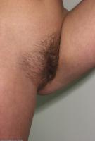 ATK hairy  in young and hairy