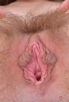 ATK hairy  in young and hairy