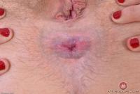 ATK hairy  in young and hairy