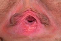 ATK hairy  in young and hairy