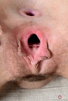 ATK hairy  in young and hairy