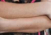 ATK hairy  in mature and hairy