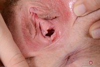 ATK hairy  in young and hairy