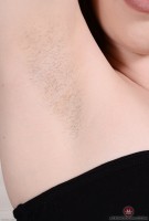 ATK hairy  in young and hairy