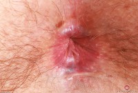 ATK hairy  in young and hairy