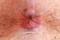 ATK hairy  in young and hairy