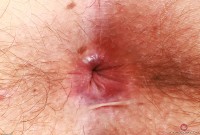 ATK hairy  in young and hairy
