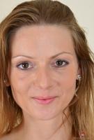 ATK hairy  in mature and hairy