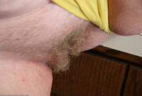ATK hairy  in mature and hairy