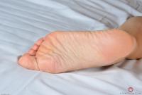 ATK hairy  in young and hairy