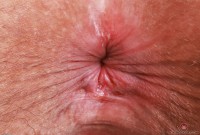 ATK hairy  in mature and hairy