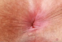 ATK hairy  in mature and hairy