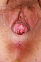 ATK hairy  in mature and hairy