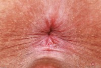 ATK hairy  in mature and hairy