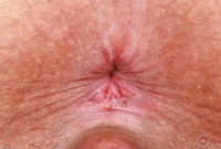 ATK hairy  in mature and hairy