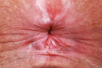 ATK hairy  in mature and hairy