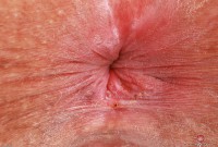 ATK hairy Remi Ferdinand Set