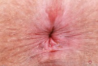 ATK hairy Remi Ferdinand Set