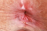 ATK hairy Remi Ferdinand in mature and hairy