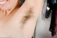 ATK hairy  in mature and hairy