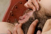 ATK hairy  in mature and hairy