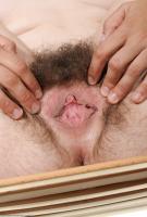 ATK hairy  in mature and hairy