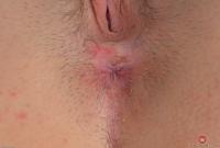 ATK hairy  in young and hairy