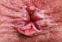 ATK hairy  in young and hairy