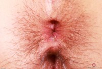 ATK hairy  in mature and hairy