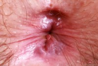 ATK hairy  in mature and hairy