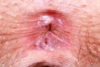 ATK hairy  in mature and hairy