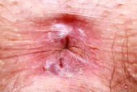 ATK hairy  in mature and hairy