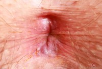 ATK hairy  in mature and hairy