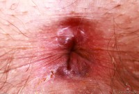 ATK hairy  in mature and hairy