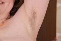 ATK hairy  in mature and hairy