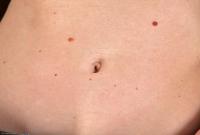 ATK hairy  in mature and hairy