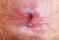 ATK hairy  in mature and hairy