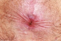 ATK hairy  in mature and hairy