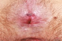 ATK hairy  in mature and hairy