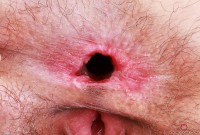 ATK hairy  in young and hairy