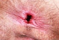 ATK hairy  in young and hairy