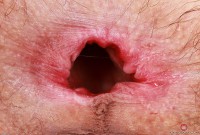 ATK hairy  in young and hairy