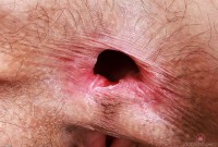 ATK hairy  in young and hairy
