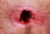 ATK hairy  in young and hairy